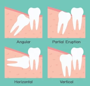 Wisdom Teeth Extraction: What You Need to Know